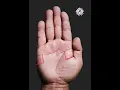 Mole In Mars Mount In Palmistry