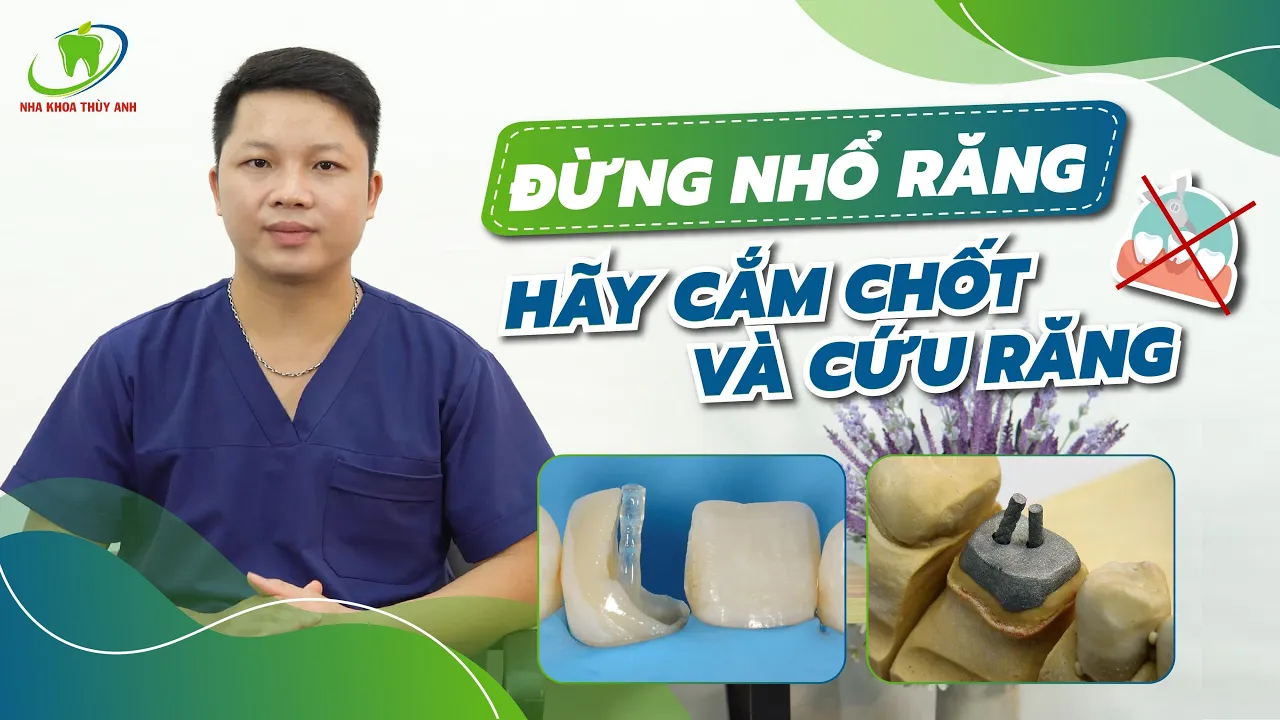 Outline Video Cắm Chốt Vào Răng Để Giữ Lại Răng Thật - Rẻ Nhưng Hiệu Quả