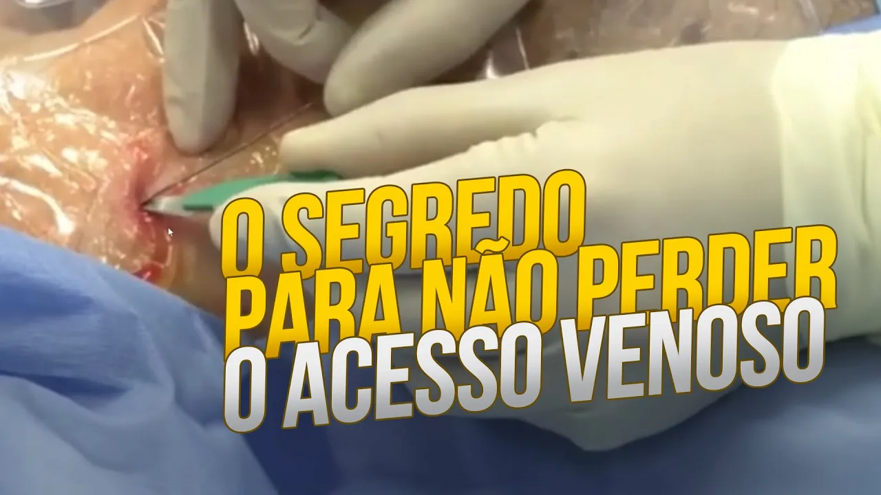 Acesso venoso central com ultrassonografia