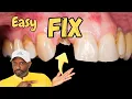 Dental Care Kit Fix Your Cosmetic Dentistry Yourself How To Fix A Broken Tooth