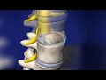 Decompression Transpedicular approach CPT code - simplify medical coding