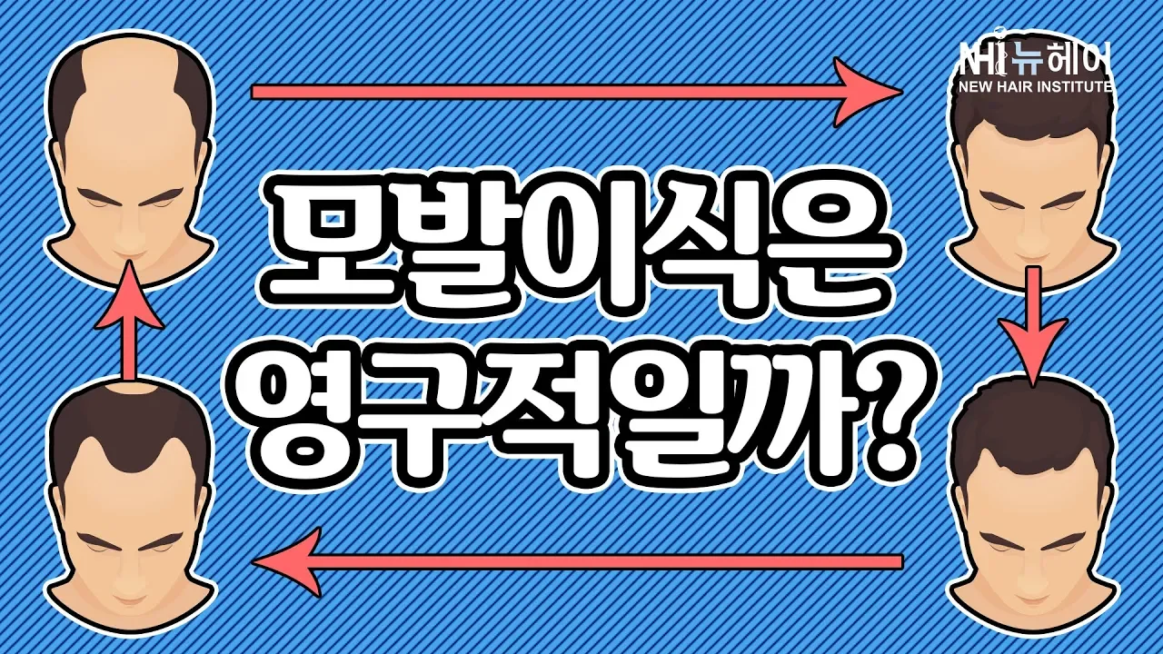 모발이식은 영구적일까?- 뉴헤어 I 모발이식 I 탈모QnA I