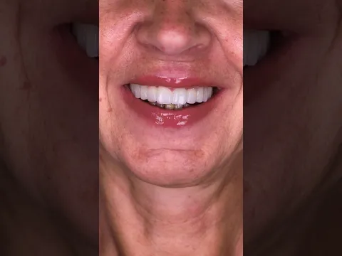 Full mouth implants done in one day #shorts #dentist #transformation