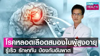 โรคหลอดเลือดสมองเกิดขึ้นได้อย่างไร และทำไมถึงพบบ่อยในผู้สูงอายุ