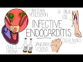 Download Lagu Infective Endocarditis (With Duke Criteria \u0026 Pathophysiology)