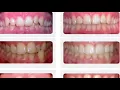 Jefferson dental fast braces