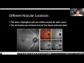 Maximizing OCT Interpretation in Glaucoma Equals Maximizing Care