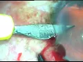 Download Lagu Manual SICS for beginners of Cataract Surgery - Pradip Mohanta