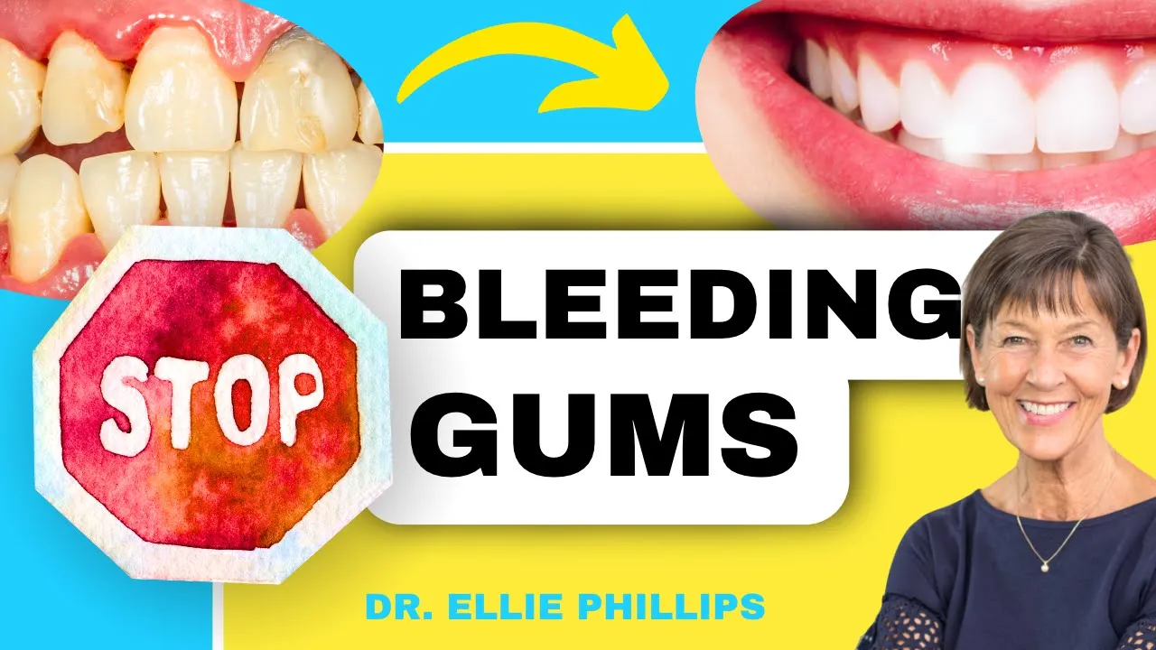 Outline Video How To QUICKLY Treat Gingivitis and Bleeding Gums