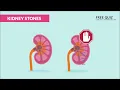 Kidney Stones Renal Calculi Nursing NCLEX RN LPN