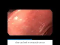 Download Lagu H. Pylori Gastritis Endoscopy