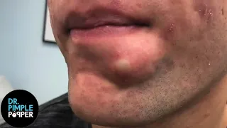 SATISFYING Dr Lee Pops Inflamed Cyst on Chin Dr Pimple Popper Reacts