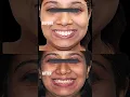 Dental Braces Before and After Dental Braces Price -
