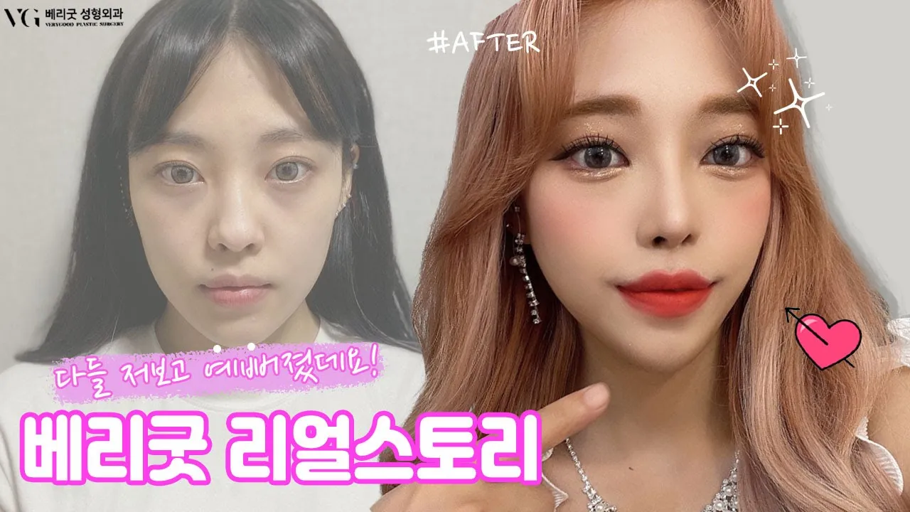 #베리굿 성형외과 다들 예뻐졌다는데??🤔어디서예뻐지는걸까? 베리굿TV에서 확.인.💘💘