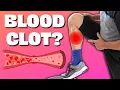 Is Your Calf Pain a Blood Clot Do Homan s Test and Find Out