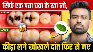 एक बार में दांत का कीड़ा और दर्द बाहर निकालने का बेहतरीन उपाय - Teeth Cavity | Fit Tuber Hindi
