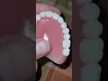 I went to Affordable Dentures and Implants My permanents
