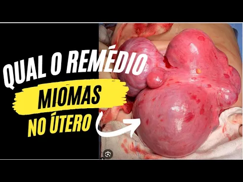 Download MP3 Remédio para mioma no útero - Dr. Michel Palheta