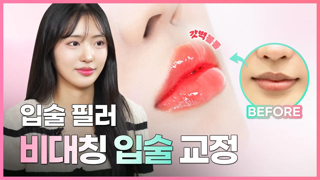 입술필러 효과 리얼 후기 | 비대칭 입술 교정 하는 입술필러 효과 & 인중 길어지는 입술필러 부작용 팩트체크 까지 !