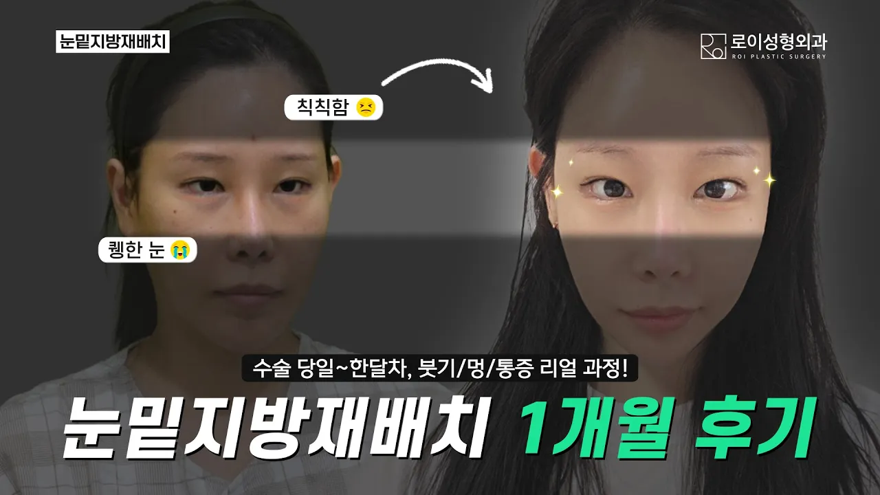👀 눈밑지방재배치 수술 당일부터 5주차 리얼 후기 | 붓기, 멍, 만족도 시기별 증상 회복과정 ✨