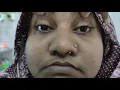 Relative Afferent Pupillary Defect RAPD