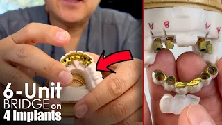How to Make an Implant Long-Span Bridge Pontic?