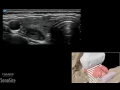 How To Pathology Thyroid 3D
