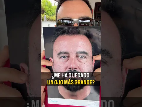 ¿Me ha quedado un ojo más grande que el otro?