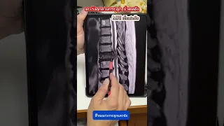  ทำไมคนที่เคยเป็นมะเร็งปอดหรือเต้านมถึงต้องระวังอาการปวดหลังรุนแรง 