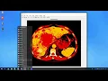 Liver Cancer Detection in Matlab