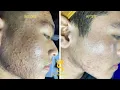 Download Lagu Acne Treatment For \