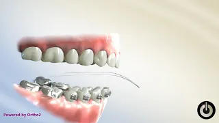 Curve of Spee Correction Lower Reverse Curve Dental Braces Temecula Valley CA