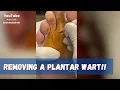 Lagu Cutting out a plantar wart! #shorts