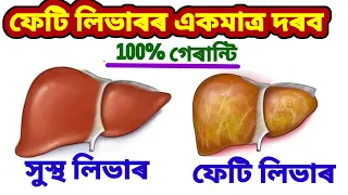 মাত্ৰ ৭ দিনত ফেটি লিভাৰ ঠিক কৰাৰ সহজ ঘৰুৱা উপায়! Fatty Liver Treatment at Home //