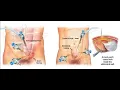 Laparoscopy hernia repair CPT code - simplify medical coding