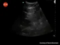 9 Tutorial on ultrasound of the Inferior Vena Cava