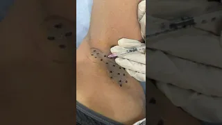 اختبار فرط التعرق لمعرفه اماكن التعرق الزائد ثم حقن البوتكس لايقاف التعرق بعد اسبوعين 