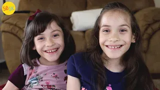 Conjoined Twins Who Were Separated A Miraculous Story
