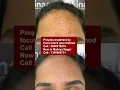 Download Lagu Best Pimples treatment by focus black peel method at skinaa clinic | Viral #shorts