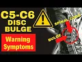 5 Warning Signs of Severe C5-C6 Disc Bulge - Dr Walter Salubro Chiropractor in Vaughan