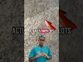 Donor area after hair transplant