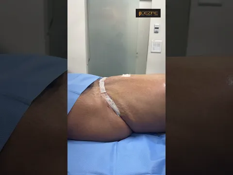 Tummy Tuck result