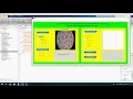 Automatic Detection of White Blood Cancer from Bone Marrow Microscopic Images Using Convolutional Ne