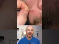 Doctor reacts to slimy pimple patch removal