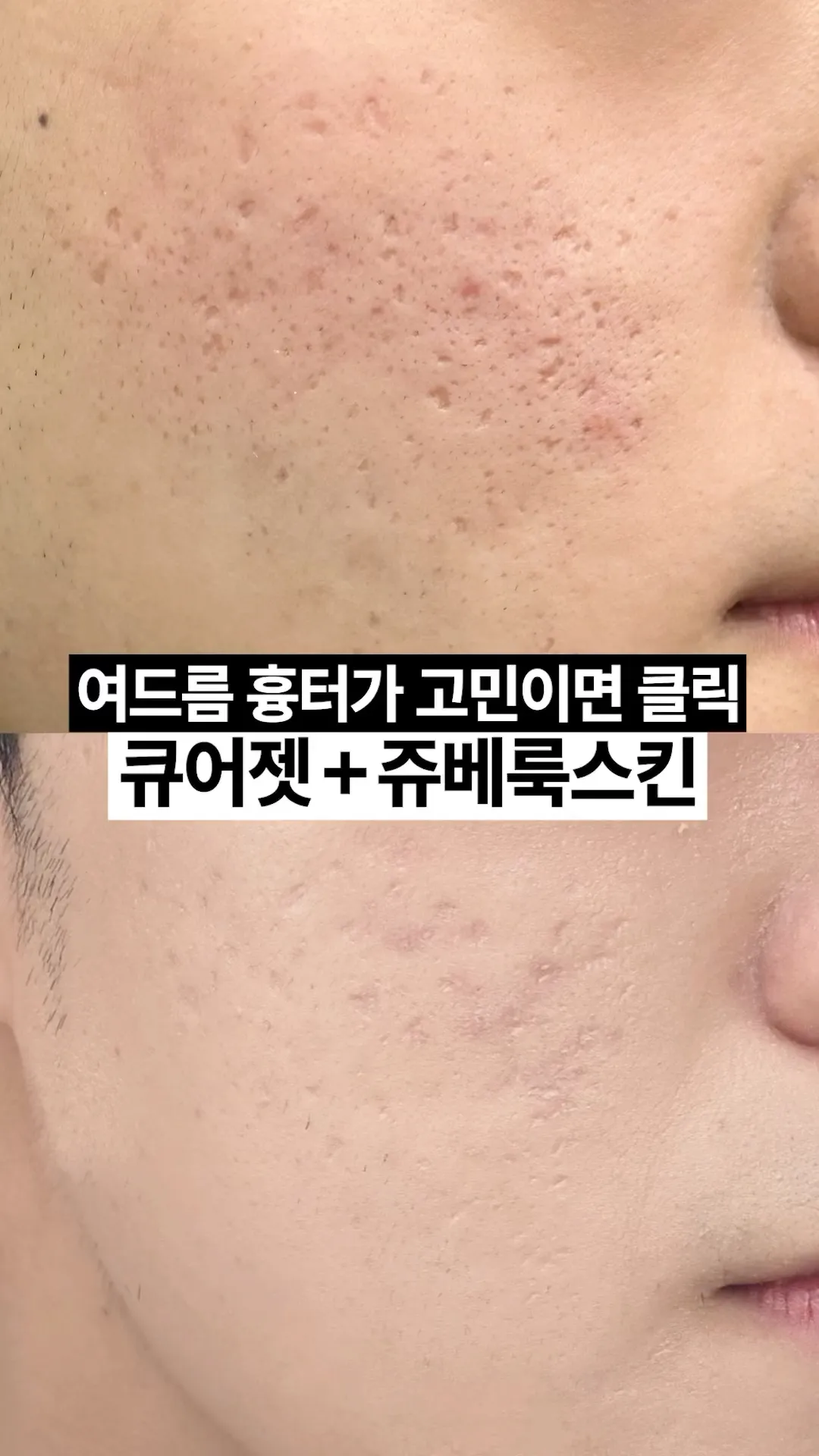 곰보피부 탈출 리얼 후기👀