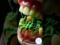 Download Lagu Bacteriën die je tanden aanvallen.🦠🦷 #tanden #tandarts #glimlach #kiem #tandheelkundige implantaten #orthodontist #albanië