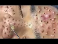 Loan Nguyen Acne Treatment 51b
