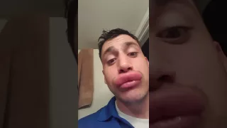 Guy Stung On Lip By Yellow Jackets Twice  Guy Stung On Lip By Yellow Jackets Twice