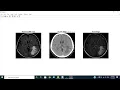 Brain Tumor Detection and classification Using CNN Engineering Project Final Year Project
