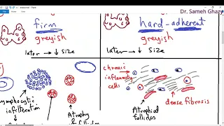 Download Systemic pathology 26 : Endocrine 1  ( thyroiditis )   DR.SAMEH GHAZY MP3